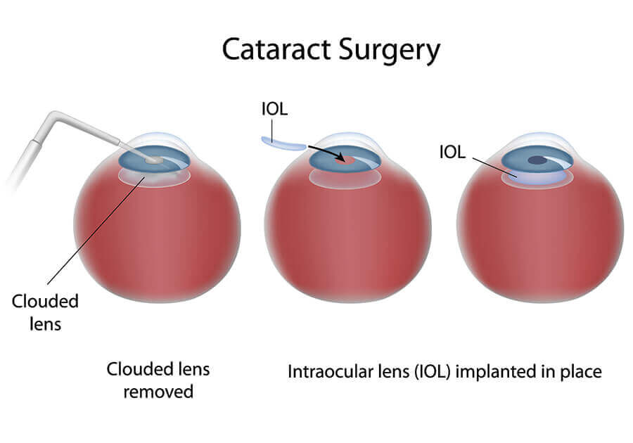 Chart Illustrating Cataract Surgery