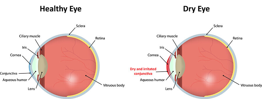 Chart Showing a Healthy Eye Compared to One With Dry Eye