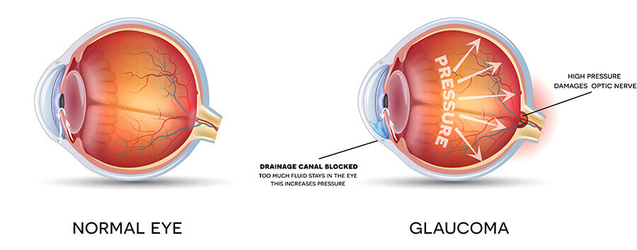 Chart Showing a Normal Eye Compared to One With Glaucoma