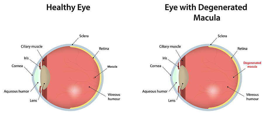 Chart Showing a Healthy Eye Compared With One With a Degenerated Macula